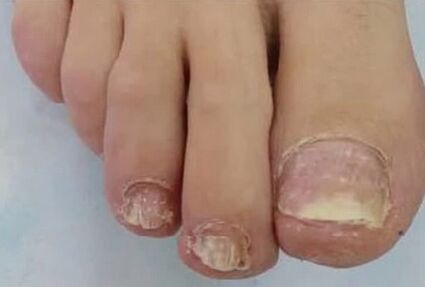 As unhas foram muito afetadas pelo fungo
